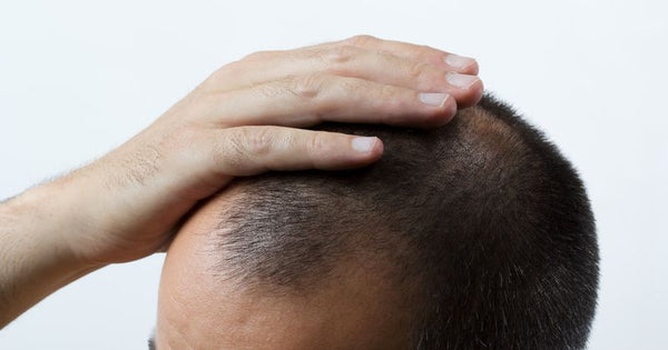 Hair Transplants vs Hair Regrowth Treatments